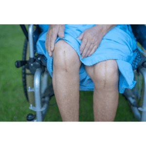 Knee Replacement, Long Island Physical Therapy and Rehab, NY
